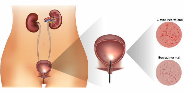 Interstitial cystitis causes pain especially when the bladder is full.