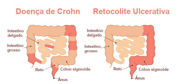 İnflamatuar bağırsak hastalıkları olmasına rağmen, Crohn hastalığı ve ülseratif kolitin farklılıkları vardır.