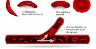 Anemia: co to jest, objawy i leczenie