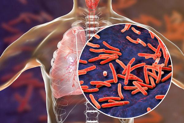 Tuberkuloos on batsilli põhjustatud haigus, mis mõjutab peamiselt kopse.