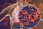 Tuberkulose: hva er det, symptomer, hvordan du kan forebygge