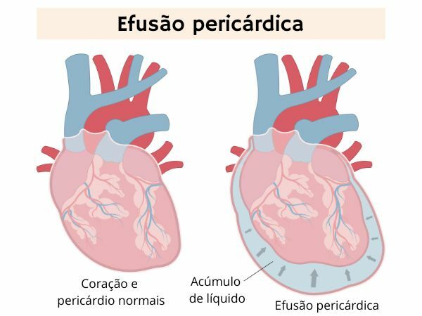 Илюстративната диаграма показва сърцето, засегнато от перикарден излив.