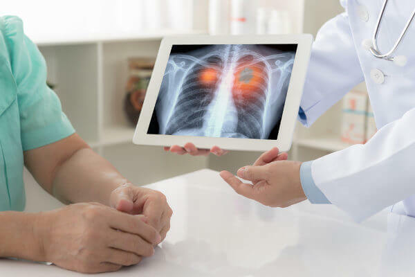 Țigările sunt legate de dezvoltarea cancerului pulmonar.