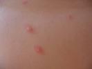 Chickenpox. Chickenpox Symptoms and Treatment
