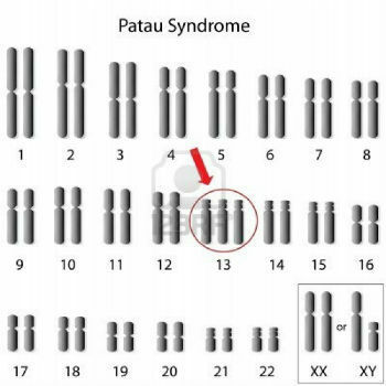 Syndróm Patau: príčiny, charakteristiky a príznaky