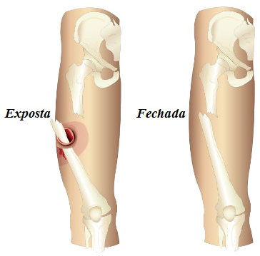 In an open fracture, it is possible to see the bone breaking the skin. In closed, this is not verified