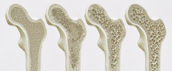 Osteoporóza: čo to je, rizikové faktory, príznaky