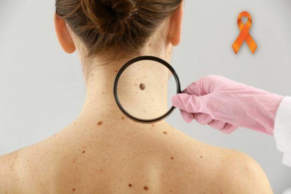 Person holds magnifying glass showing white woman's mole December Orange Skin cancer