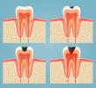Caries. What forms cavities?