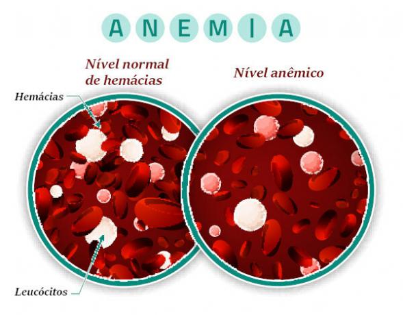 При анемия може да се наблюдава намаляване на концентрацията на хемоглобин или намаляване на броя на червените кръвни клетки.