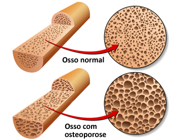 Osteoporosis en hueso con deficiencia de calcio