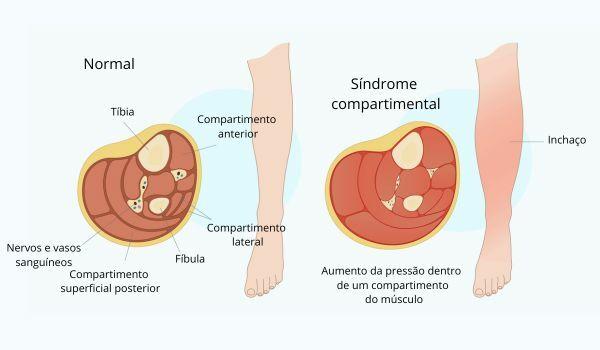 Normalna noga z oteklino, ki je posledica kompartment sindroma, posledice rabdomiolize.