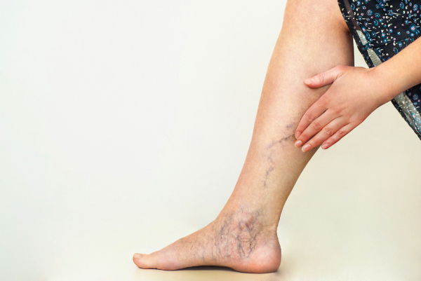 Varicose veins are tortuous and dilated veins that most often occur in the lower limbs.