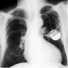 A pacemakert működőképes akkumulátor lítium-jód akkumulátor.