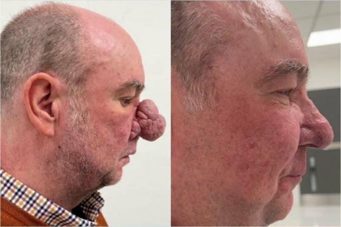 „Žmogui dramblys“ buvo atlikta nenormalios nosies korekcijos operacija; Pažiūrėkite, kaip tai pasirodė!