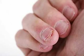 Nawyk obgryzania paznokci. Czy obgryzanie paznokci jest złe?