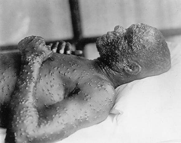 Man with smallpox.