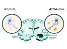 Alzheimerjeva bolezen: vzroki, simptomi, stopnje, zdravljenje