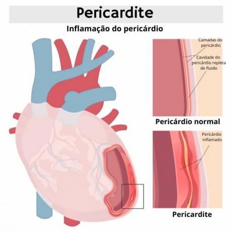 A szemléltető diagram a pericarditis által érintett szívet mutatja.