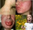 Аллергии. Из чего они состоят, что это такое и как лечить аллергию