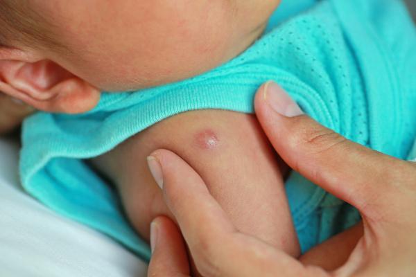 Photo of a newborn, focusing on his arm, where he was vaccinated with BCG.