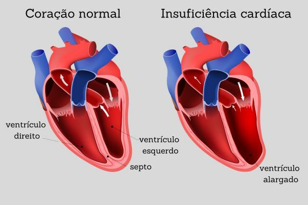 Srdcové zlyhanie: príčiny, symptómy, štádiá
