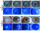 Vízia obnovená: terapia kmeňovými bunkami vracia zrak pacientom; pozri