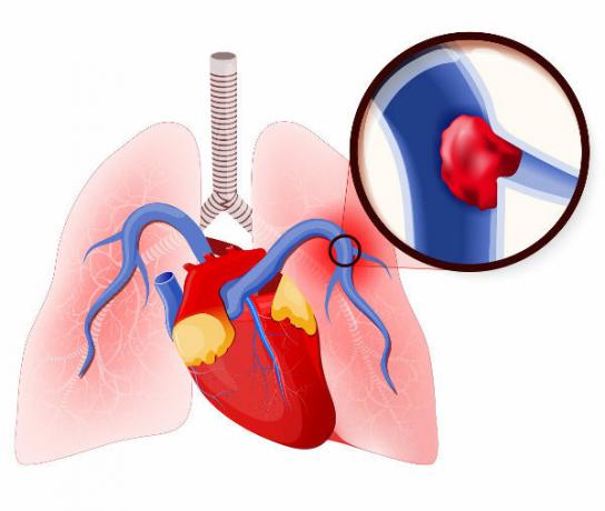 Plućna embolija nastaje uslijed začepljenja plućne arterije ili njezinih grana.