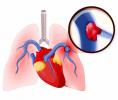 심부 정맥 혈전증이란 무엇입니까? 심 부정맥 혈전증