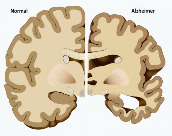Ilustracija možganov s poškodbami zaradi Alzheimerjeve bolezni, bolezni, povezane z demenco.