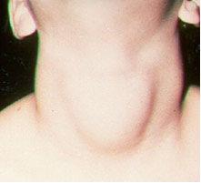 A lack of iodine in the body causes a condition called goiter. 