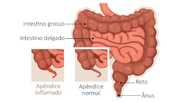Appendix: vad det är, funktioner, blindtarmsinflammation, symtom