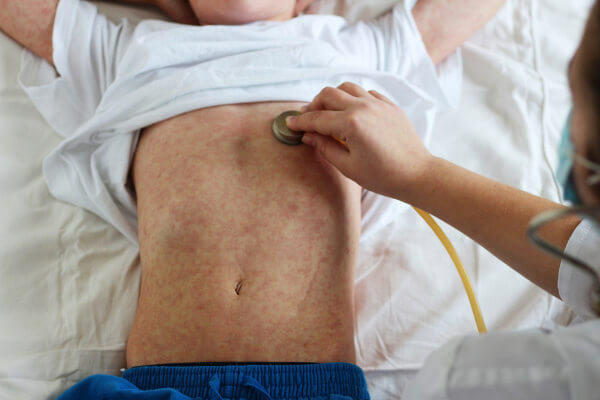 10 common questions about measles