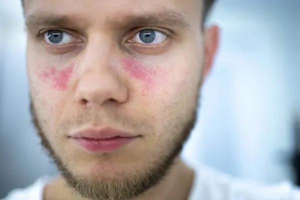 Weißer Mann mit roten Flecken im Gesicht