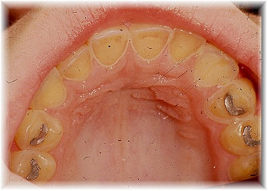 Булімія призводить до швидкого руйнування зубів