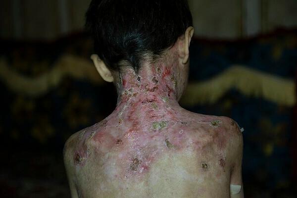 Η πλάτη ενός παιδιού που έχει προσβληθεί από μπουλόζα επιδερμόλυσης.