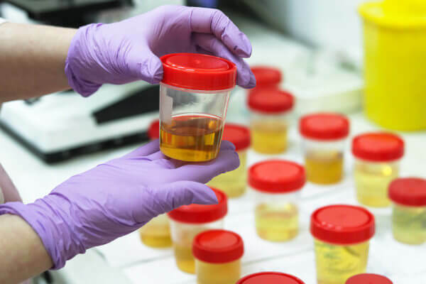 Analiza urina lahko ugotovi primer okužbe sečil.