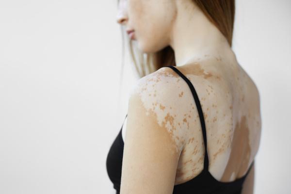 Vitiligo: što je to, uzroci, simptomi, liječenje