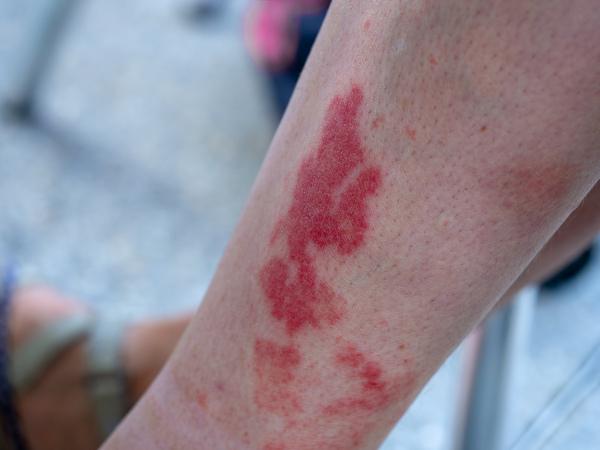 A close-up view of a person's leg with patches of skin that have arisen as a result of vasculitis.