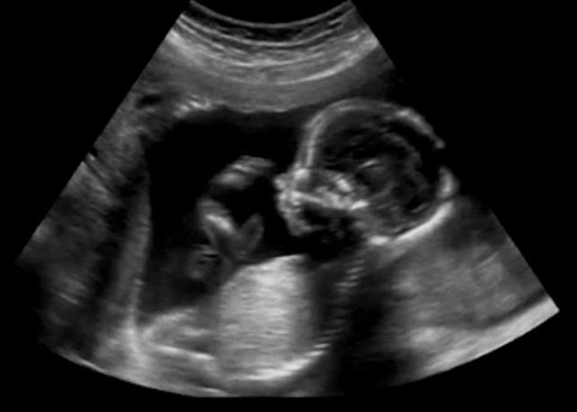Ultraljudstest används ofta för att bestämma barnets kön från den trettonde graviditetsveckan.