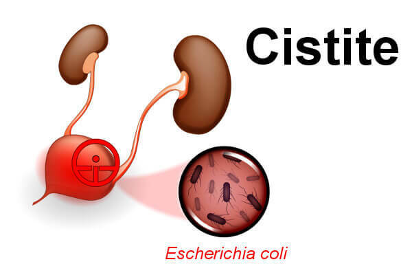 Една от основните бактерии, причиняващи цистит, е Escherichia coli. 