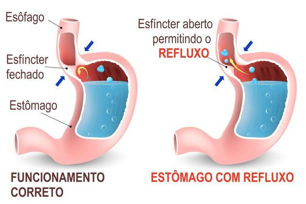 gastroezofaginis refliuksas