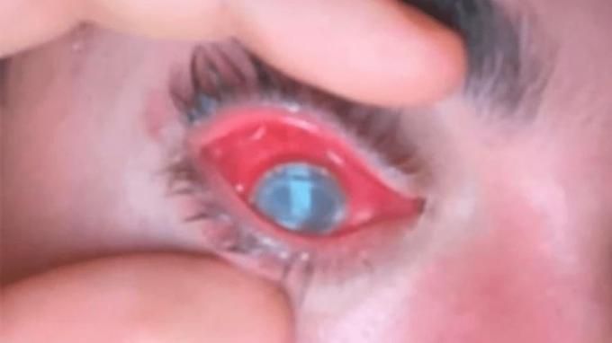 Mann schläft mit Kontaktlinsen und seine Augen werden von Parasiten befallen