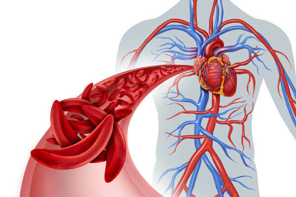 Bij sikkelcelanemie hebben rode bloedcellen een sikkelvorm.