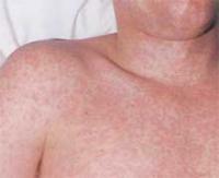 Characteristic of rubella: reddish patches on the skin