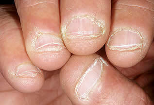 Покусанные ногти делают руки некрасивыми