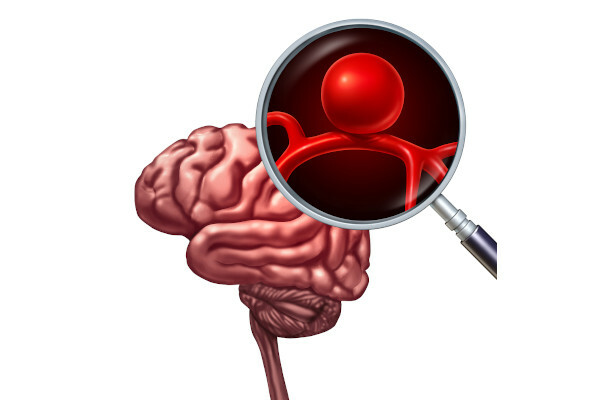 Tętniak mózgu występuje bardziej w postaci tętniaka torebkowego.