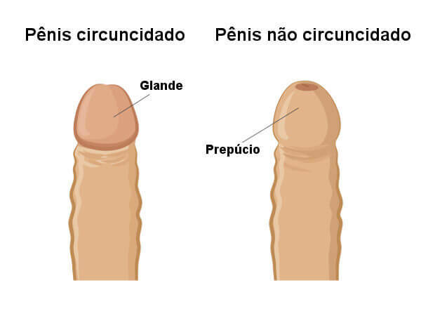 In circumcision, the foreskin is removed.