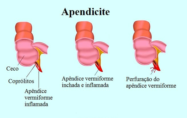 apendicīts