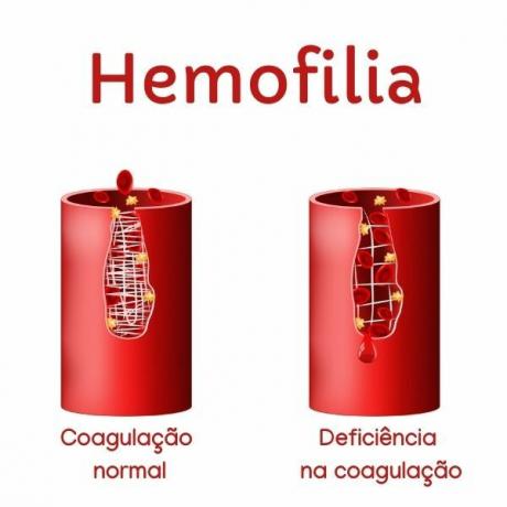 Hemofilija sergantiems pacientams yra krešėjimo problemų, dėl kurių užsitęsia kraujavimas.